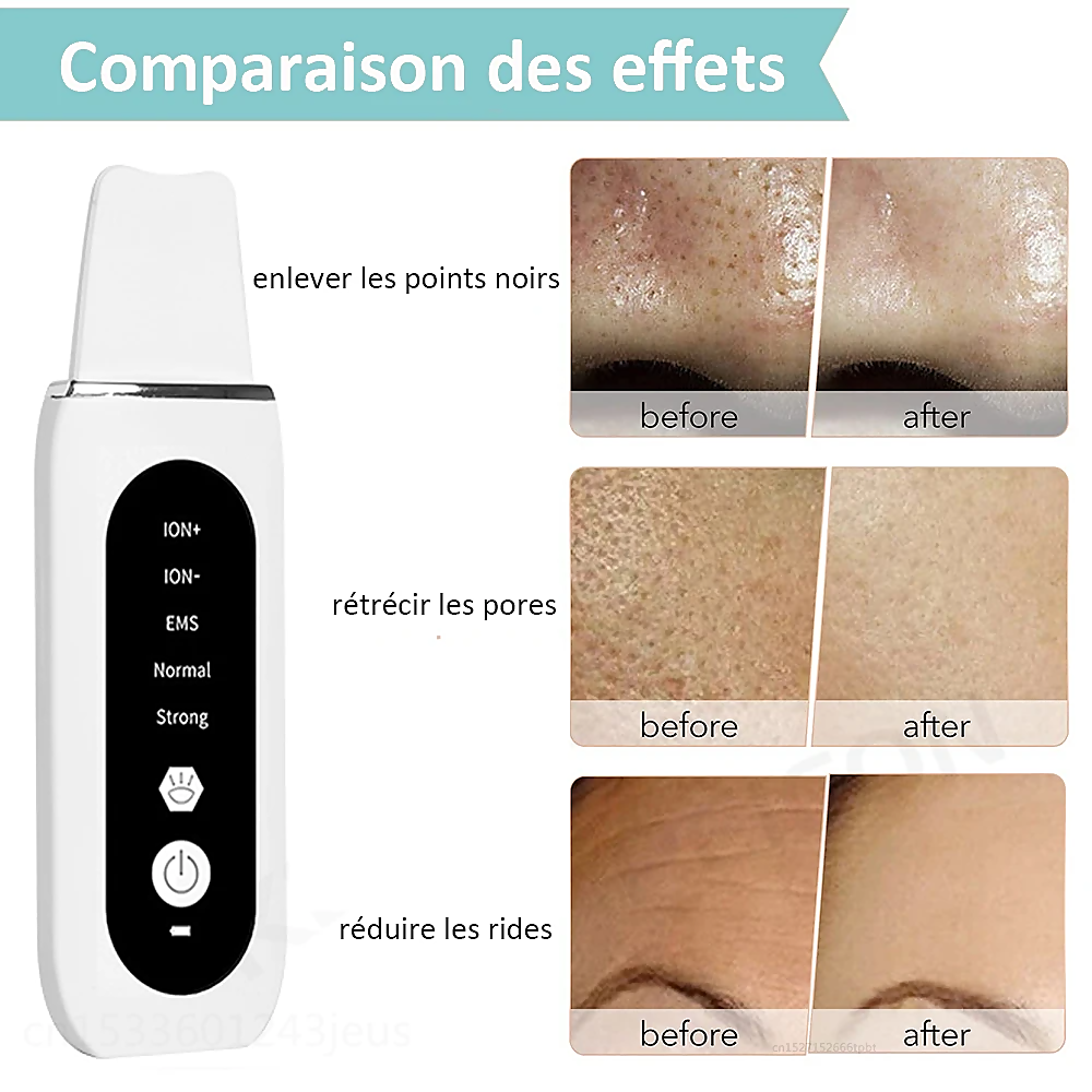 STELLAR - 5-Function EMS Lifting Exfoliator - Ultrasound & Photon Treatment-10