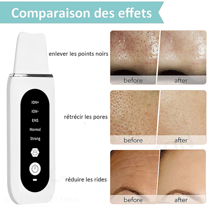 STELLAR - 5-Function EMS Lifting Exfoliator - Ultrasound & Photon Treatment-10